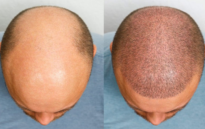 Greffe de Cheveux